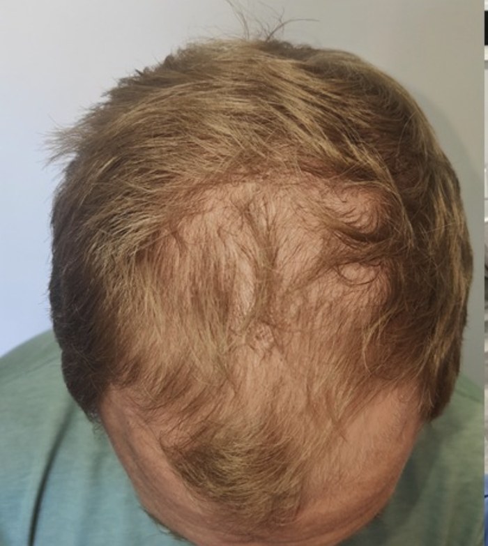 Antes do transplante capilar - caso 3
