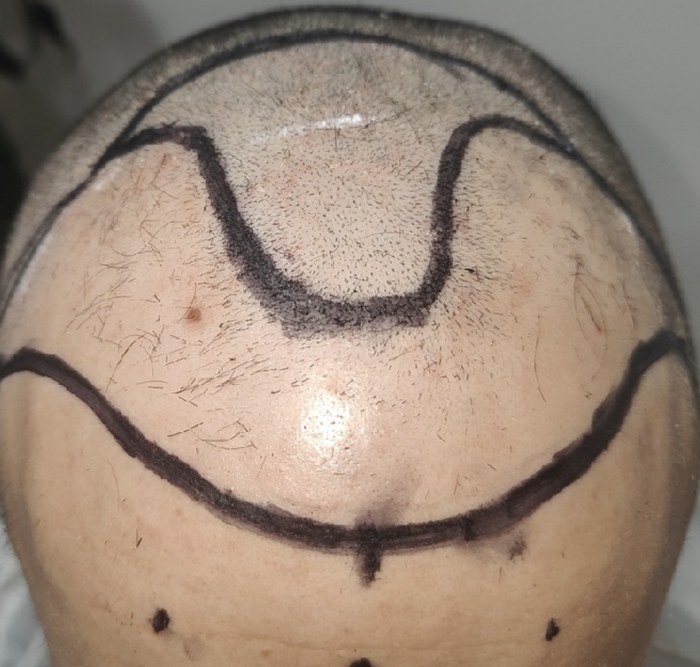 Antes do transplante capilar - caso 1
