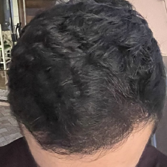Depois do transplante capilar - caso 1