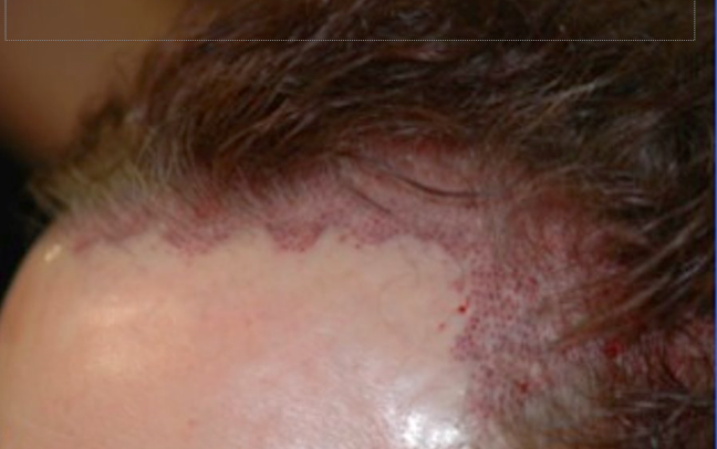 Antes do transplante capilar com técnica FUE Long Hair