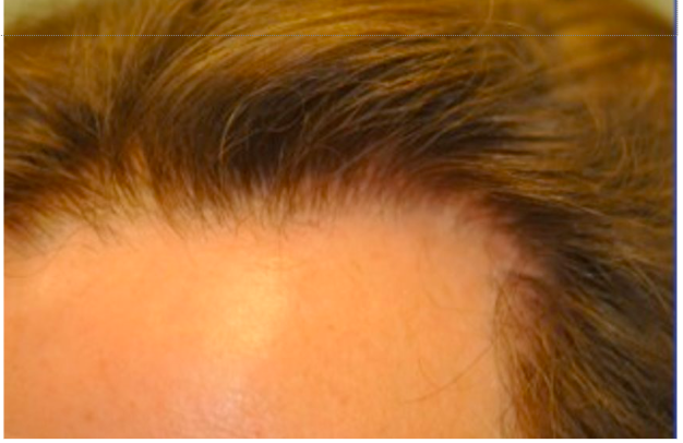 Depois do transplante capilar com técnica FUE Long Hair
